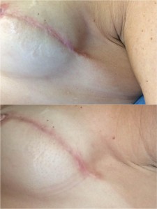 Cicatrices por cirugía de mastectomía