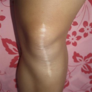 tratamiento cicatrices rodillas