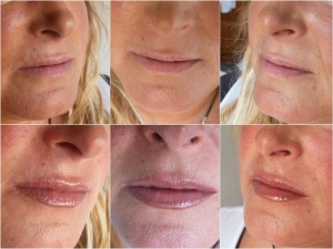 tratamientos esteticos labios